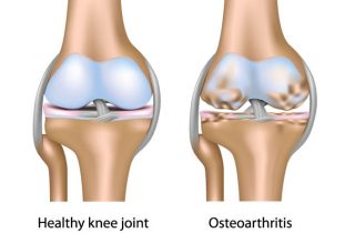 Healthy knee joint versus osteoarthritis